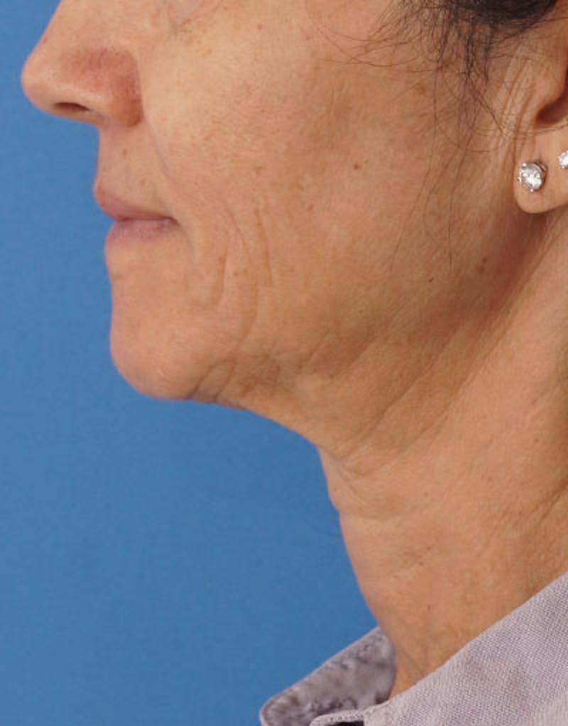 FaceTite Before & After Gallery - Patient 136492 - Image 9