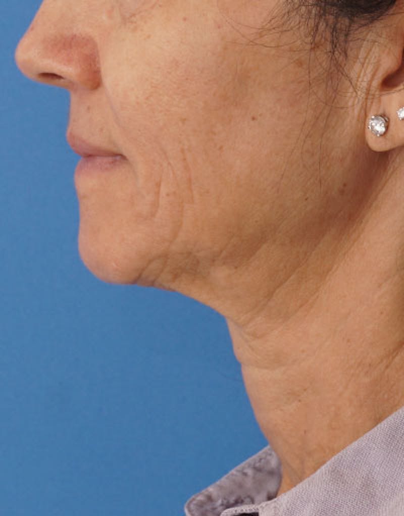 FaceTite Before & After Gallery - Patient 136492 - Image 7