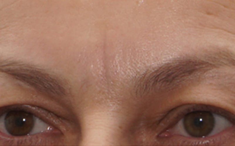 BOTOX Before & After Gallery - Patient 136826 - Image 4