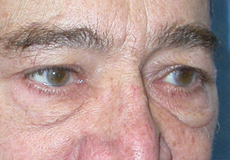 Eyelid Surgery Before & After Gallery - Patient 341727 - Image 3