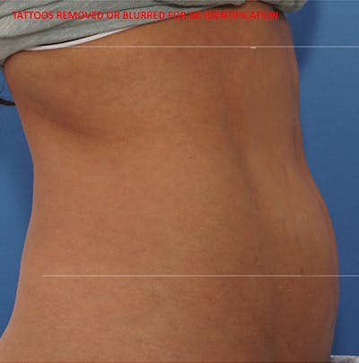 Liposuction (Body) Before & After Gallery - Patient 125542 - Image 1