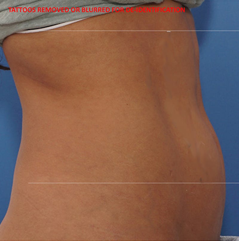 BodyTite Before & After Gallery - Patient 708589 - Image 1