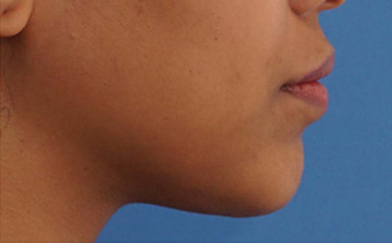 Chin Surgery Before & After Gallery - Patient 212061 - Image 2