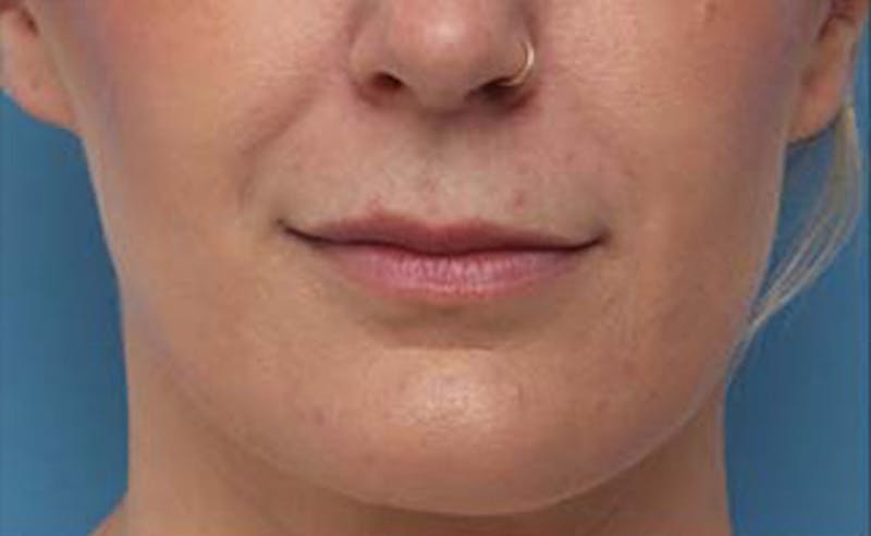 Lip Fillers Before & After Gallery - Patient 332883 - Image 1