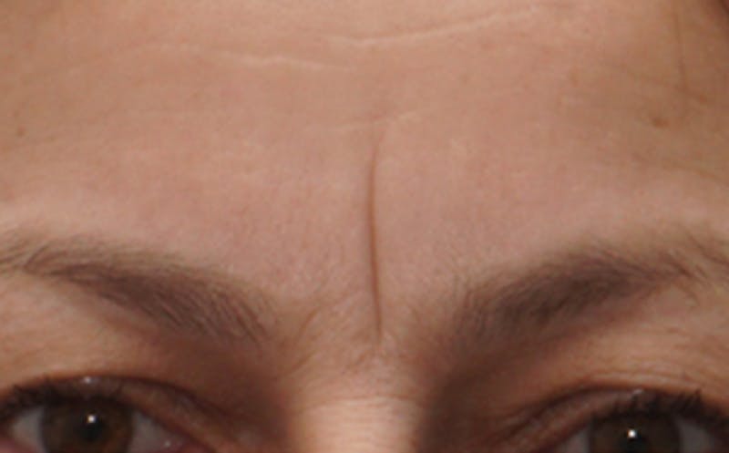 BOTOX Before & After Gallery - Patient 136826 - Image 5
