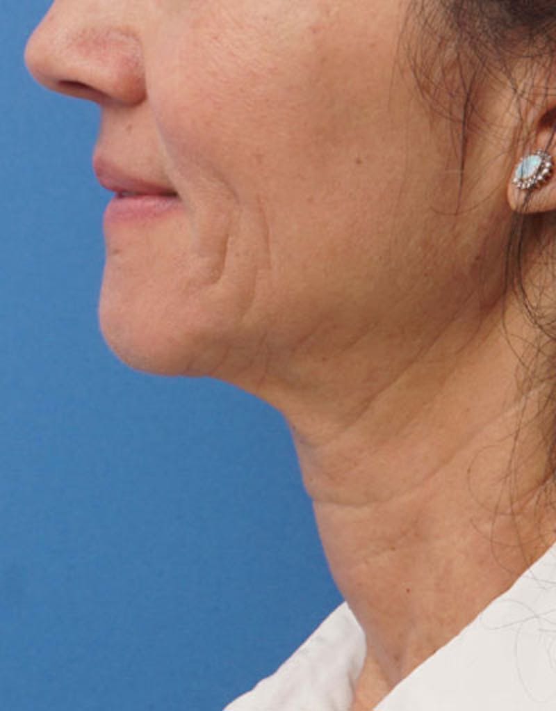 FaceTite Before & After Gallery - Patient 136492 - Image 8