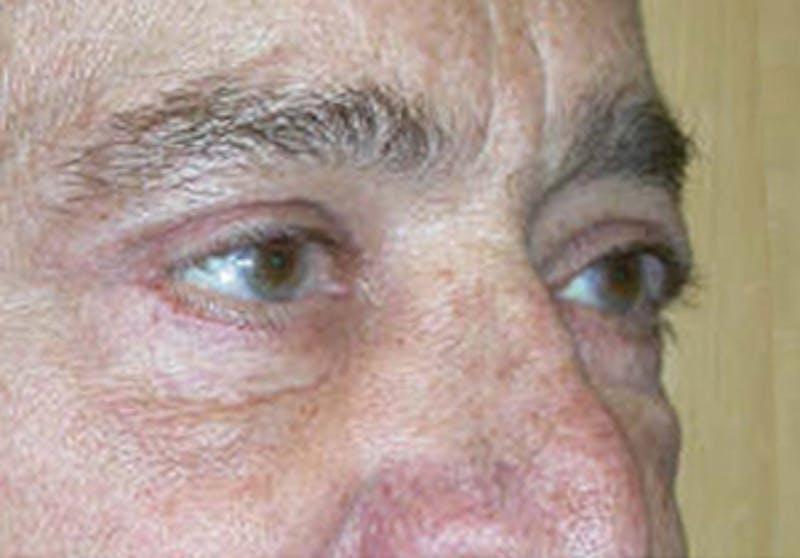 Eyelid Surgery Before & After Gallery - Patient 341727 - Image 4