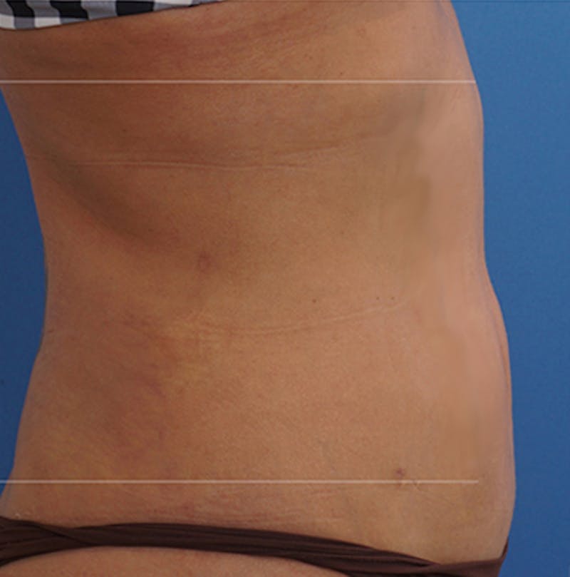 BodyTite Before & After Gallery - Patient 708589 - Image 2