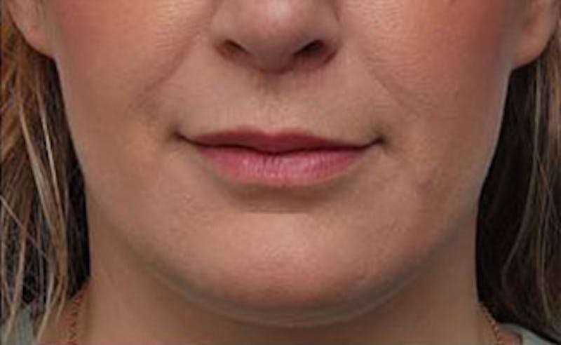 Lip Fillers Before & After Gallery - Patient 332883 - Image 2