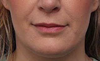 Lip Fillers Before & After Gallery - Patient 332883 - Image 2