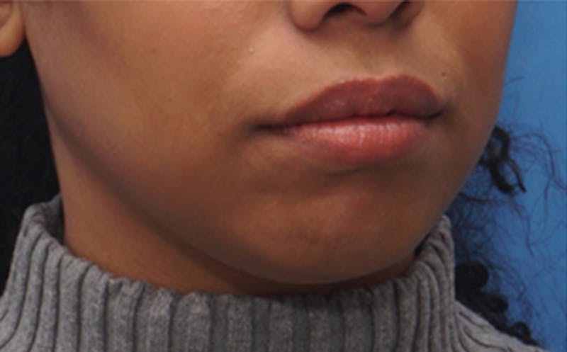 Chin Surgery Before & After Gallery - Patient 212061 - Image 3