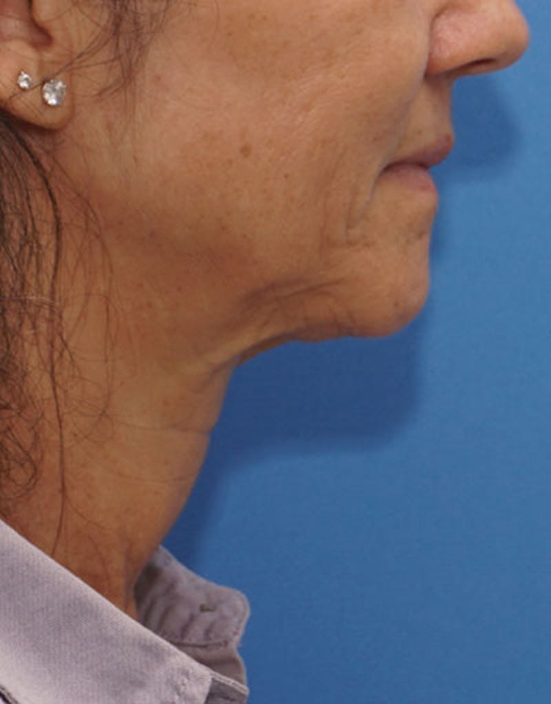 FaceTite Before & After Gallery - Patient 136492 - Image 9