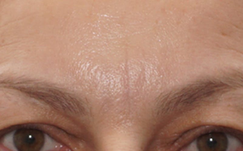 BOTOX Before & After Gallery - Patient 136826 - Image 6