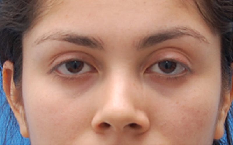 Fillers Before & After Gallery - Patient 100711 - Image 1