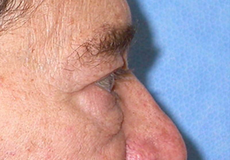 Eyelid Surgery Before & After Gallery - Patient 341727 - Image 5