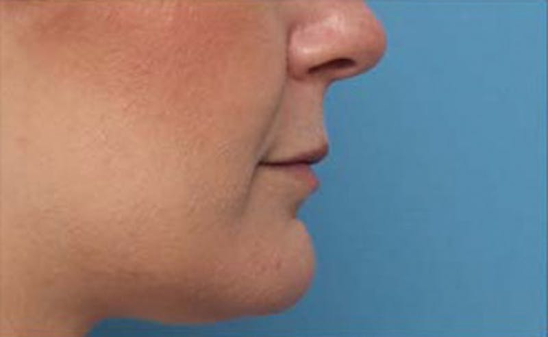 Lip Fillers Before & After Gallery - Patient 332883 - Image 3