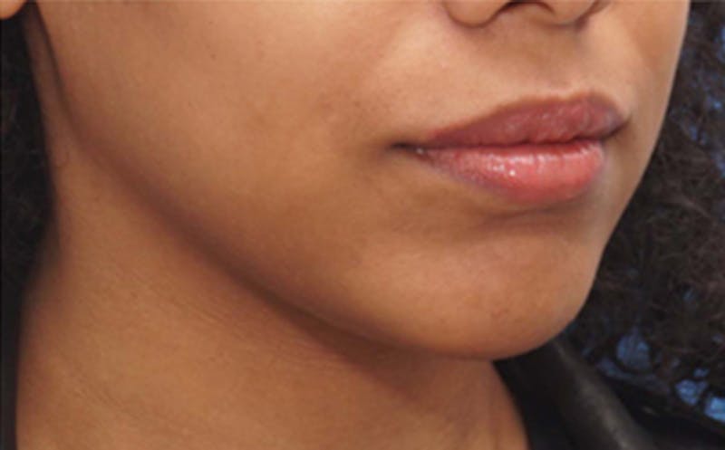 Chin Surgery Before & After Gallery - Patient 212061 - Image 4