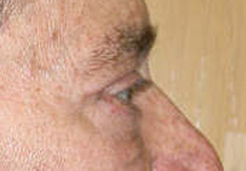 Eyelid Surgery Before & After Gallery - Patient 341727 - Image 6