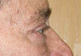 Eyelid Surgery Before & After Gallery - Patient 341727 - Image 6