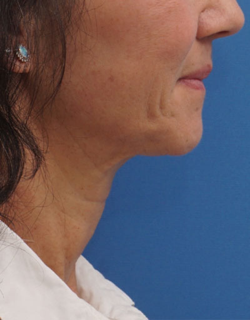 FaceTite Before & After Gallery - Patient 136492 - Image 10