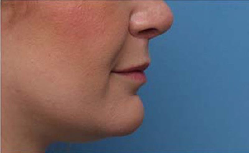 Lip Fillers Before & After Gallery - Patient 332883 - Image 4