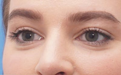 BOTOX Before & After Gallery - Patient 406834 - Image 1