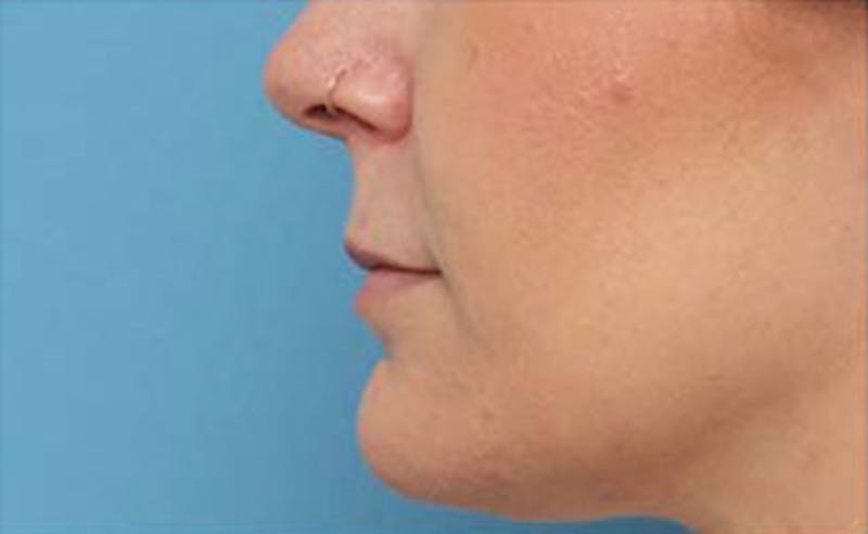 Lip Fillers Before & After Gallery - Patient 332883 - Image 5
