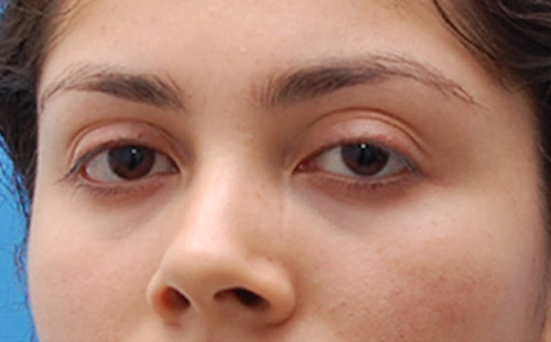 Fillers Before & After Gallery - Patient 100711 - Image 3