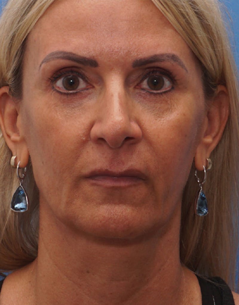 Patient NBkF1KQDQEO3FaPZeFEtOg - FaceTite Before & After Photos