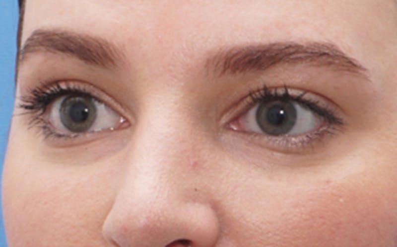BOTOX Before & After Gallery - Patient 406834 - Image 2