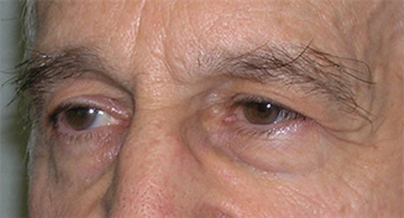 Patient DE65N0H7Tx2rZ4Gz34s3dA - Eyelid Surgery Before & After Photos