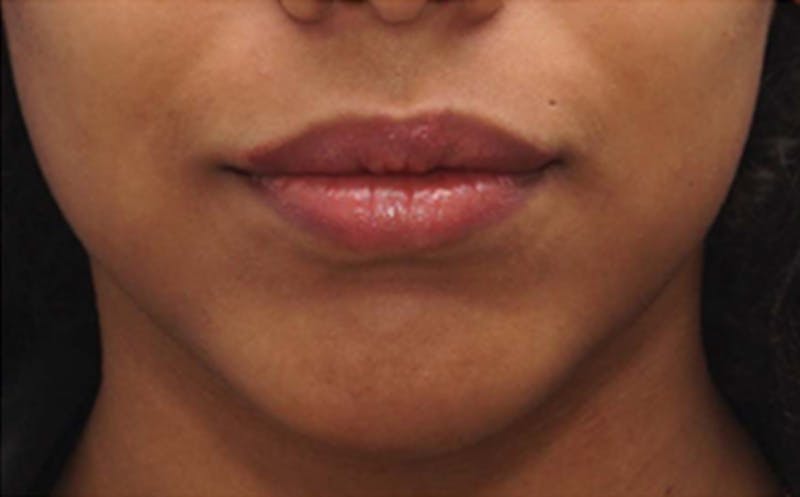 Chin Surgery Before & After Gallery - Patient 212061 - Image 6