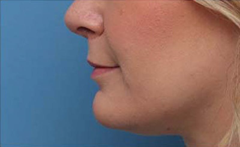 Lip Fillers Before & After Gallery - Patient 332883 - Image 6