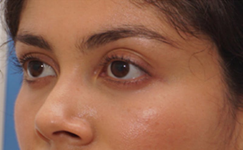 Fillers Before & After Gallery - Patient 100711 - Image 4