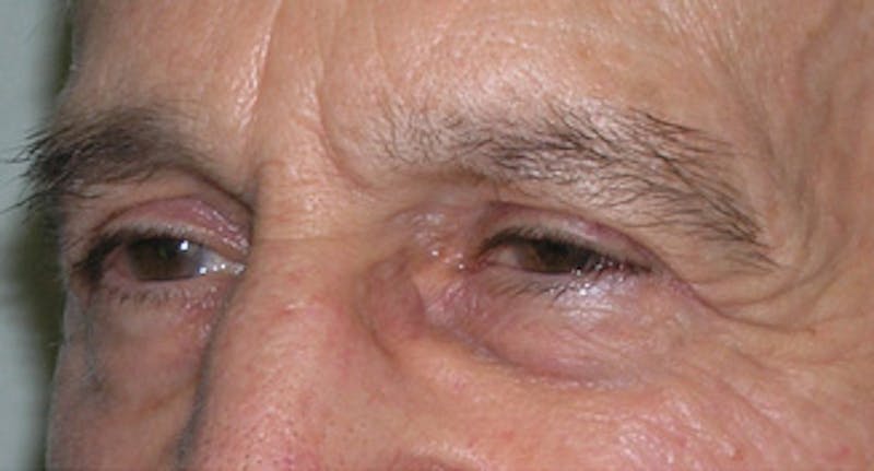 Eyelid Surgery Before & After Gallery - Patient 500033 - Image 2