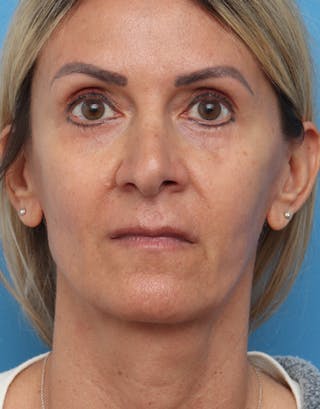 FaceTite Before & After Gallery - Patient 301341 - Image 2