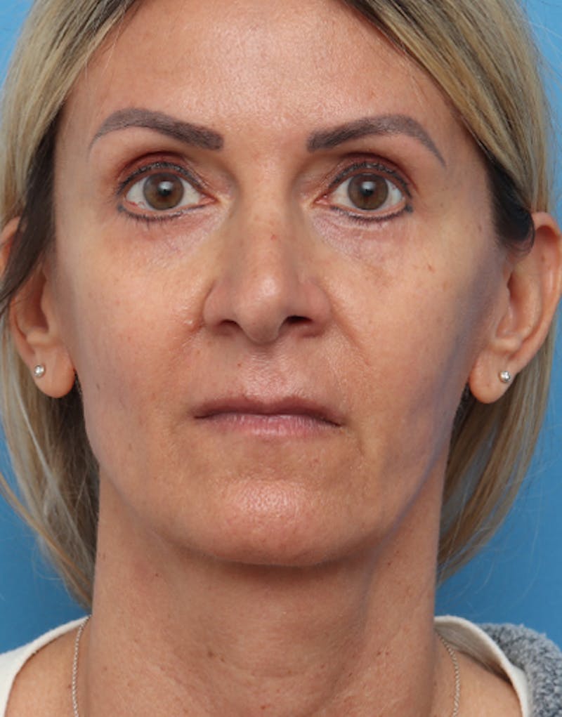 FaceTite Before & After Gallery - Patient 301341 - Image 2