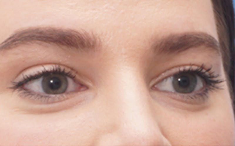 BOTOX Before & After Gallery - Patient 406834 - Image 3