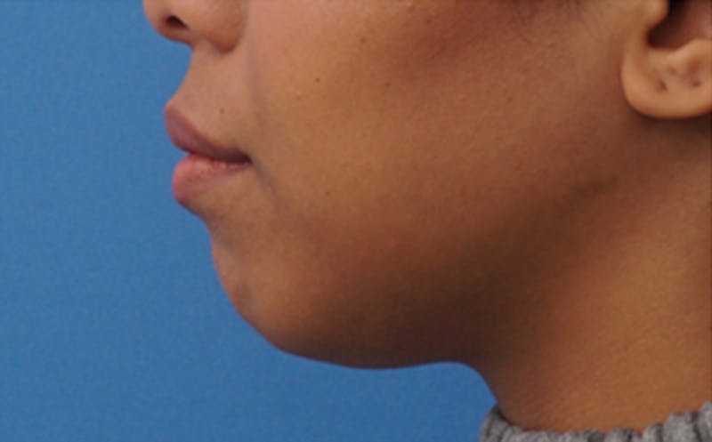 Chin Surgery Before & After Gallery - Patient 212061 - Image 7