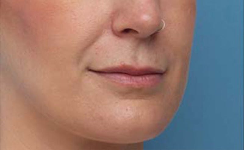 Lip Fillers Before & After Gallery - Patient 332883 - Image 7