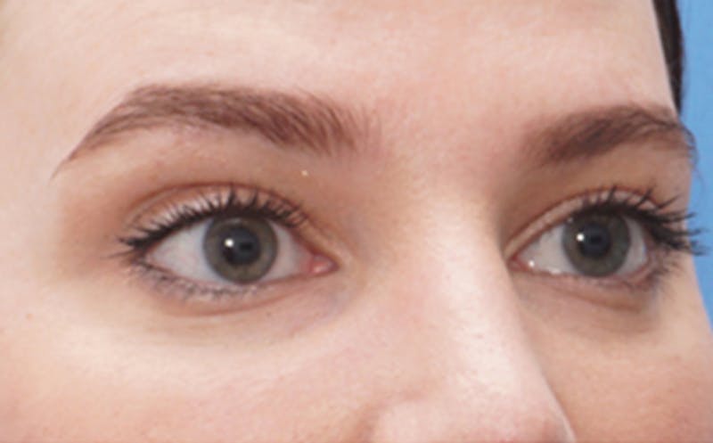 BOTOX Before & After Gallery - Patient 406834 - Image 4