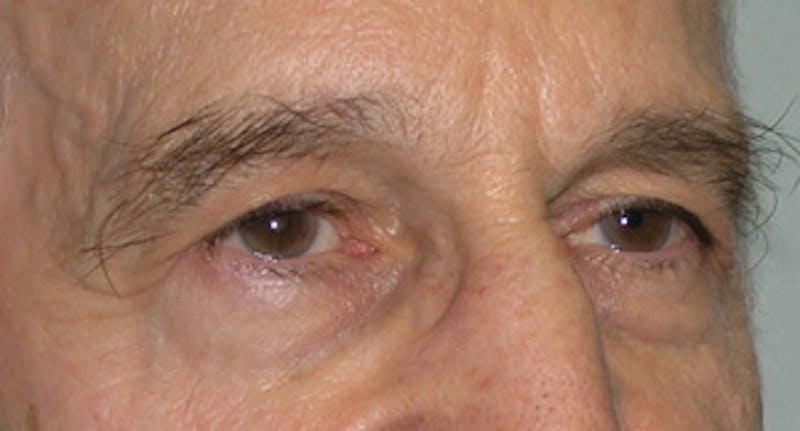 Eyelid Surgery Before & After Gallery - Patient 500033 - Image 3