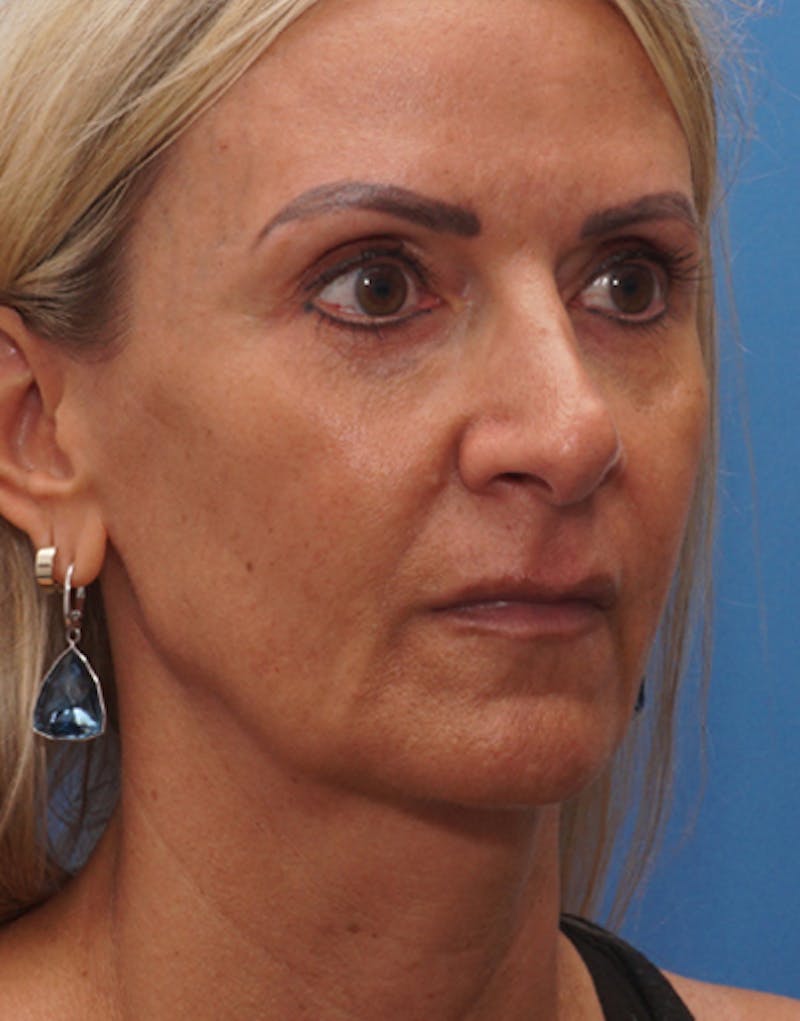 FaceTite Before & After Gallery - Patient 301341 - Image 3