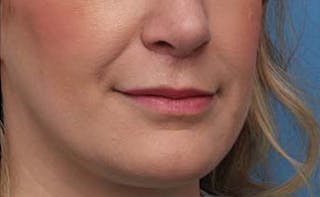 Lip Fillers Before & After Gallery - Patient 332883 - Image 8