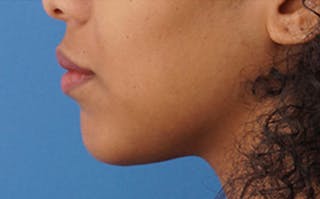 Chin Surgery Before & After Gallery - Patient 212061 - Image 8