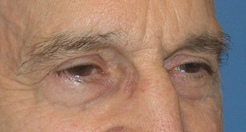 Eyelid Surgery Before & After Gallery - Patient 500033 - Image 4