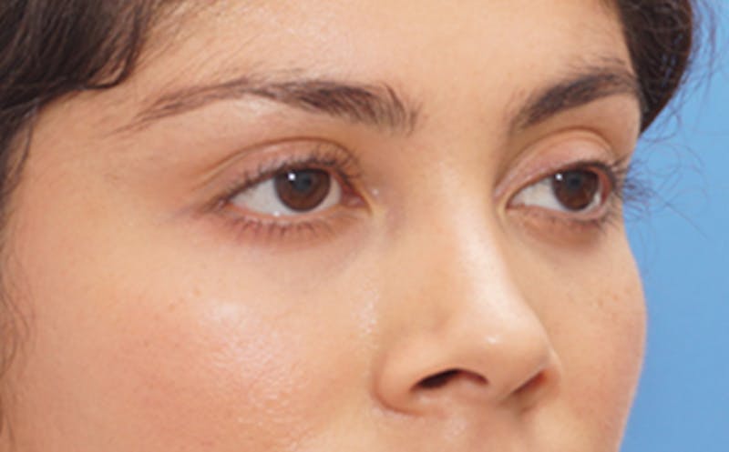 Fillers Before & After Gallery - Patient 100711 - Image 6