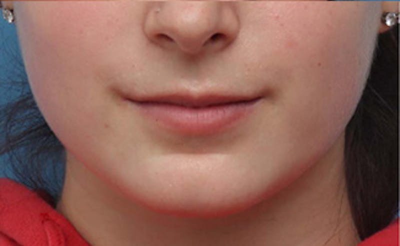 Lip Fillers Before & After Gallery - Patient 164524 - Image 1