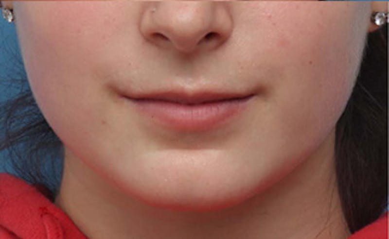 Patient LGi6ApqxScGRj-fBNjOlJQ - Lip Enhancement Before & After Photos