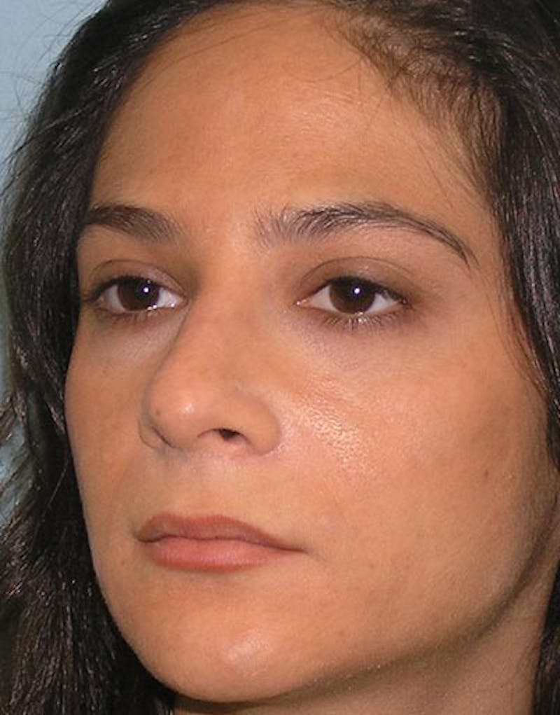 Rhinoplasty Before & After Gallery - Patient 143589 - Image 1